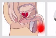 Contusiones en el pene y el escroto en niños y adultos: tratamiento después de un golpe