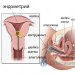 Pipelle endometrial biopsiyası: bu nədir, necə aparılır