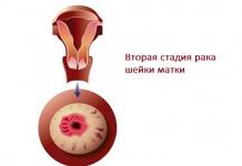 Značajke tijeka raka vrata maternice druge faze