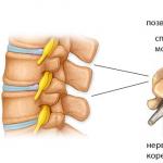 Spinal hemangioma: contraindications Treatment procedures for spinal hemangioma
