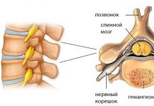 Onurğa hemangioması: əks göstərişlər Onurğa hemangioması üçün müalicə prosedurları
