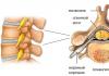 Hemangiom kralježnice: kontraindikacije Postupci liječenja hemangioma kralježnice