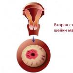 Características del curso del cáncer de cuello uterino de la segunda etapa.